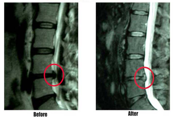 IDD Therapy treatment before & after patient MRI with herniated disc
